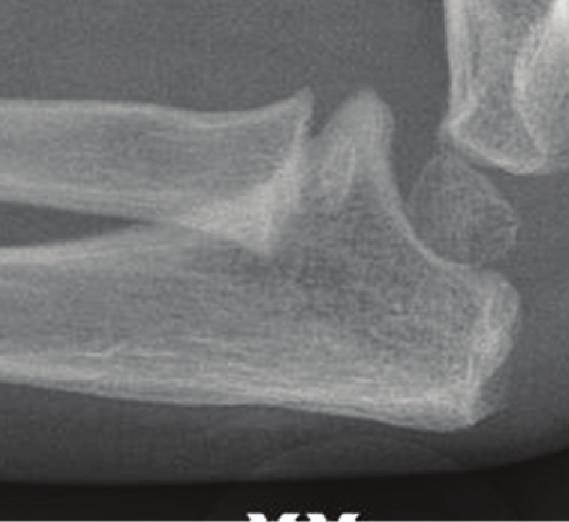 References Figure6:Anteroposteriorradiographfourmonthspostoperatively. Note the union of the olecranon fracture and the satisfactory position of the radiocapitellar joint.
