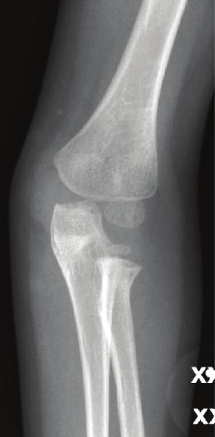 In summary, we report a traumatic medial radial head dislocation associated with a displaced olecranon fracture.