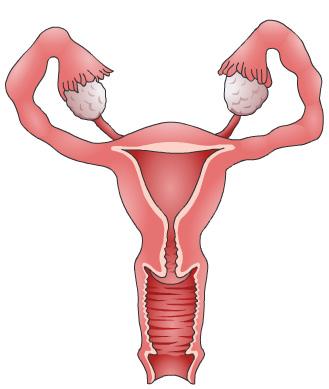 Acute Salpingitis Introduction Acute salpingitis is a type of infection that affects the Fallopian tubes. The Fallopian tubes carry eggs from the ovaries to the uterus.