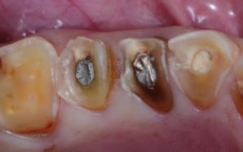 Miniml intervention dentistry: prt 5. Ultr-conservtive pproch to the tretment of erosive nd rsive lesions P. Colon* 1 nd A.