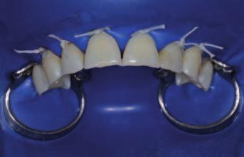 A direct technique ws used s the sole intervention to void ll cvity preprtion. A comintion of indirect nd direct techniques for the sme tooth hs een well documented.