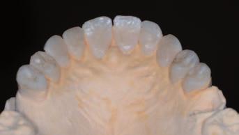 15 It is quite esy to uild indirect composite restortions on model without ny dentl preprtion. However, depth of 0.