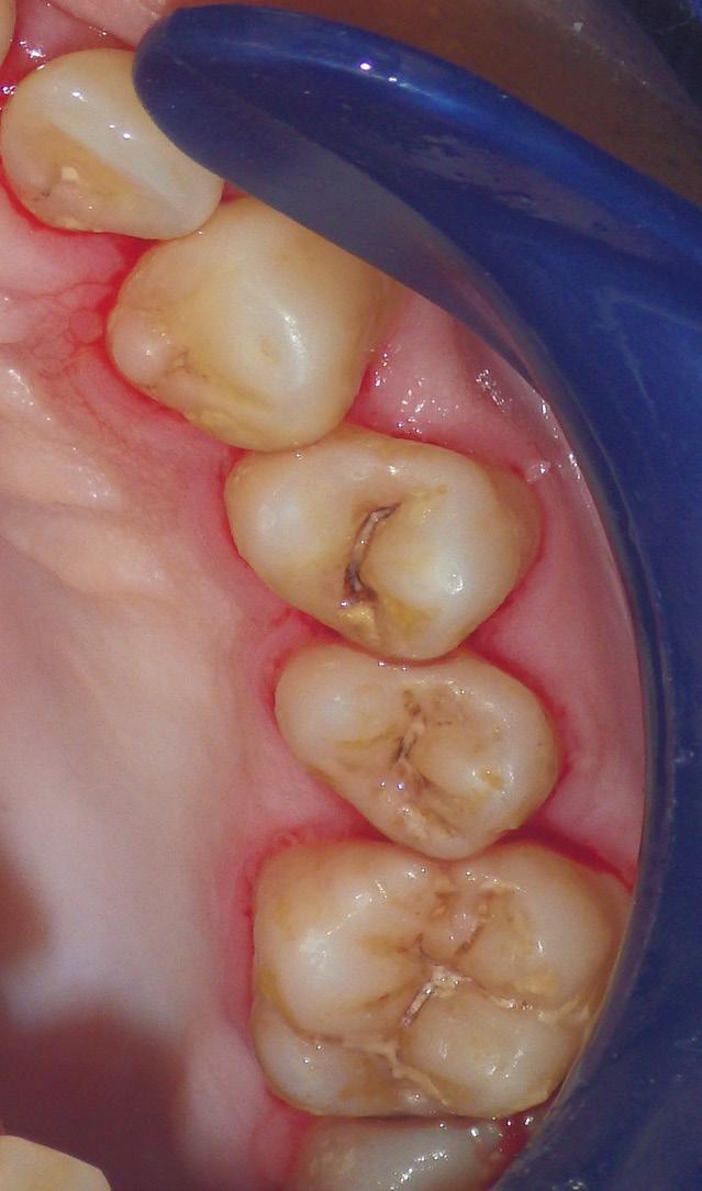Figures 2 and 2. 2 (Pre-Op) Initial ICDS 2 lesions2 present on teeth 24 and 25. Tooth # 41 with an advanced lesion prior to treatment.