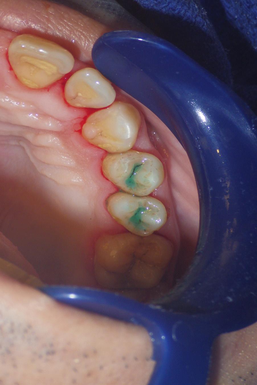 Figure 6. Polyacrylic acid over the entire occlusal tooth surface applied with a microbrush Figure 7. GIC sealants placed on teeth # 24 and # 25 Figures 8 and 8.