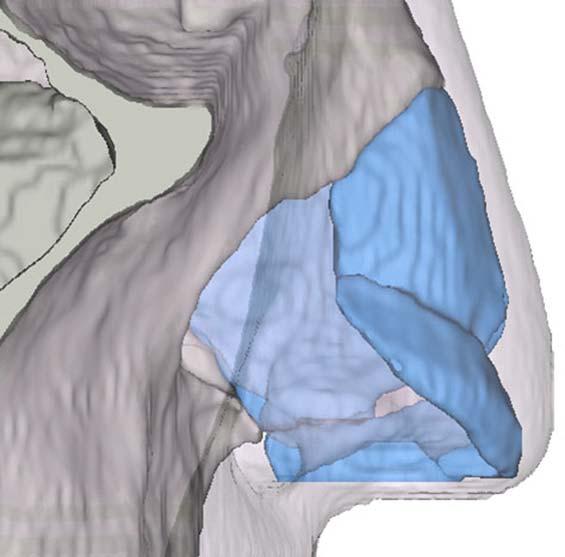 TABLE I. Major and Minor Nasal Tip Support Mec
