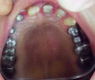 maxillary arch after stage II