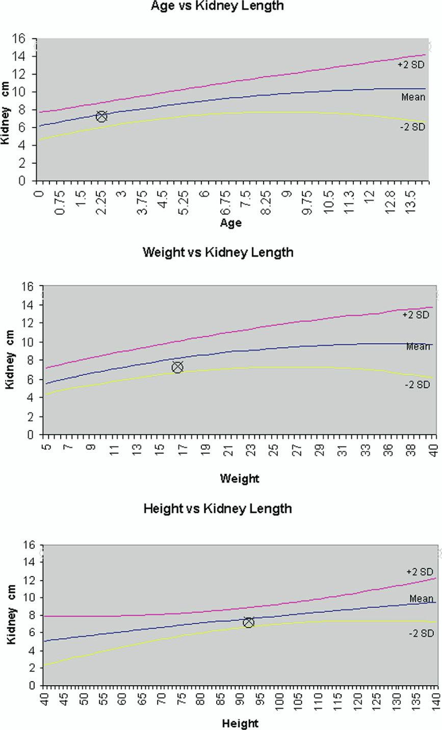 264 M.A. Rossleigh Figure 2 Nomograms of renal lengths for age, height, and weight have been established. with ureteric reimplantation.