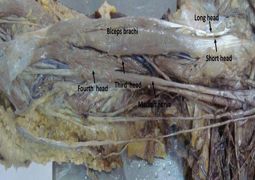 Upper limb muscles presents with a wide range of variations in the form of accessory muscles, accessory heads of origin or ectopic site of origin.