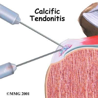 Introduction Calcific tendonitis of the shoulder happens when calcium deposits form on the tendons of your shoulder.
