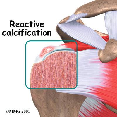 Ironically, it is during this stage that pain is most likely to occur. In the post-calcific stage, the body heals the tendon, and the tendon is remodeled with new tissue.