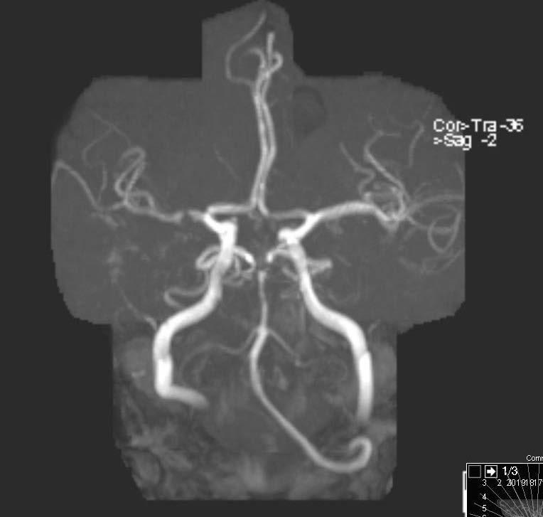 Case-1 60 years old male with left sided weakness CT shows subacute right frontal