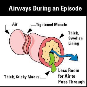 What happens during an asthma attack? Three things happen in the airways of the lungs during an asthma attack: 1. The airways get swollen. Doctors call this inflammation.
