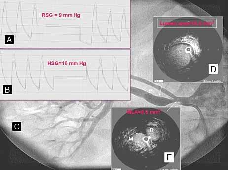 quantitative angiographic and IVUS analyses. Panel C shows the segment with poststenotic dilation.