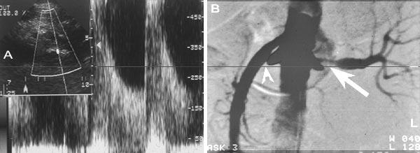 78 THE MOUNT SINAI JOURNAL OF MEDICINE March 2004 Fig. 1. A. Renal artery duplex ultrasound from the anterior approach. The Doppler is placed in the proximal left renal artery.