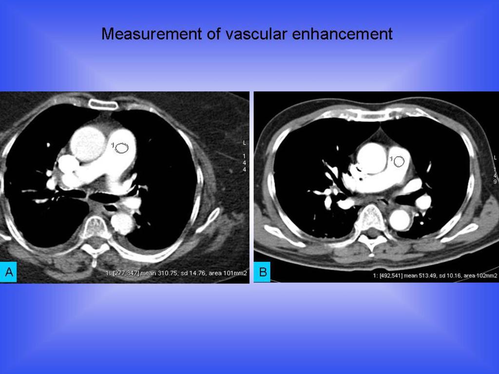 Fig. 0: Contrast enhanced CT pulmonary arteriogram in mediastinal window setting(ww 400 ; WL 100) demonstrating the comparison of vascular enhancement at the level of main pulmonary artery (A)
