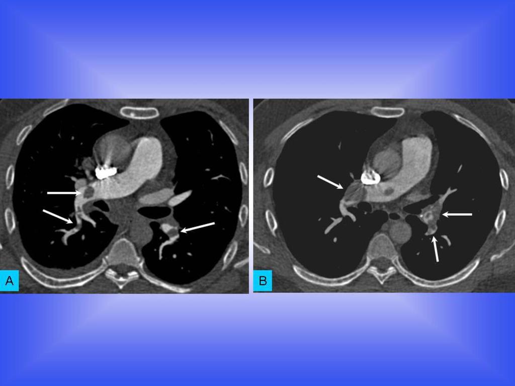 Fig. 0: Contrast enhanced CT pulmonary studies in Axial sections at the level of the main pulmonary artery in two patients with pulmonary embolism demonstrating the comparison of image quality at the