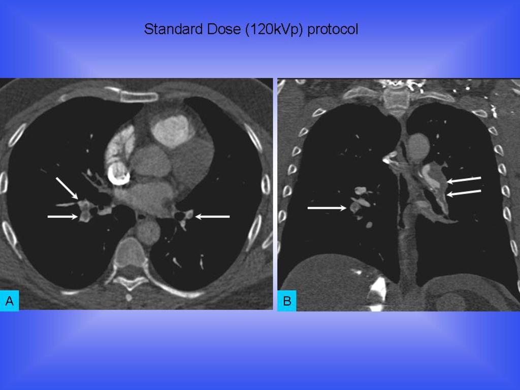 Fig. 0: Contrast enhanced CT pulmonary arteriogram in pulmonary artery window (WW 1600 ; WL 700) in a 42 year old male with history of cough and breathlessness demonstrating filling defects at the