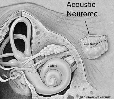 Menieres Acoustic Neuroma Medical