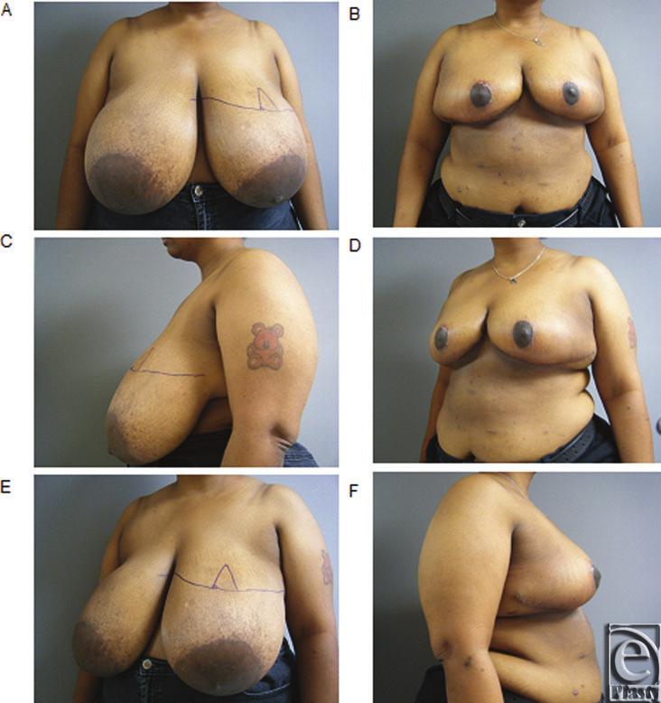 DEGEORGEETAL Figure 2. (a-f) Representative preoperative and postoperative breast photograph series in patient with gigantomastia demonstrating no vertical scar reduction mammoplasty.