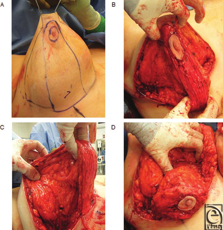eplasty VOLUME 13 Figure 4. Representative preoperative reduction mammoplasty markings. (a)overview of markings. (b) Marking of the apex point.