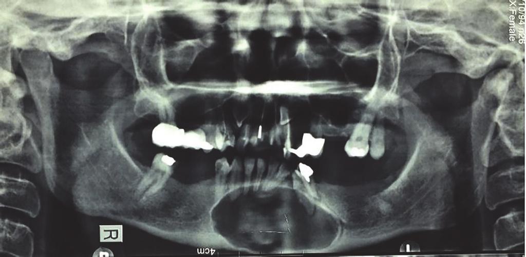 2 Case Reports in Radiology Figure 1: Panoramic radiograph shows a single large radiolucent lesion with well-defined border.