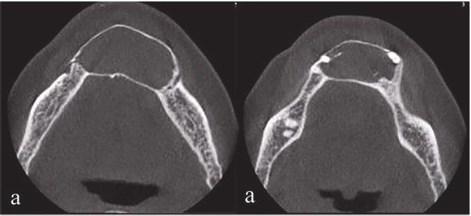 Case Reports in Radiology 3 (a) (b) (c) Figure 2: (a) Axial sections show that mental foramen is not involved but has close contact with border of the lesion at the left side.