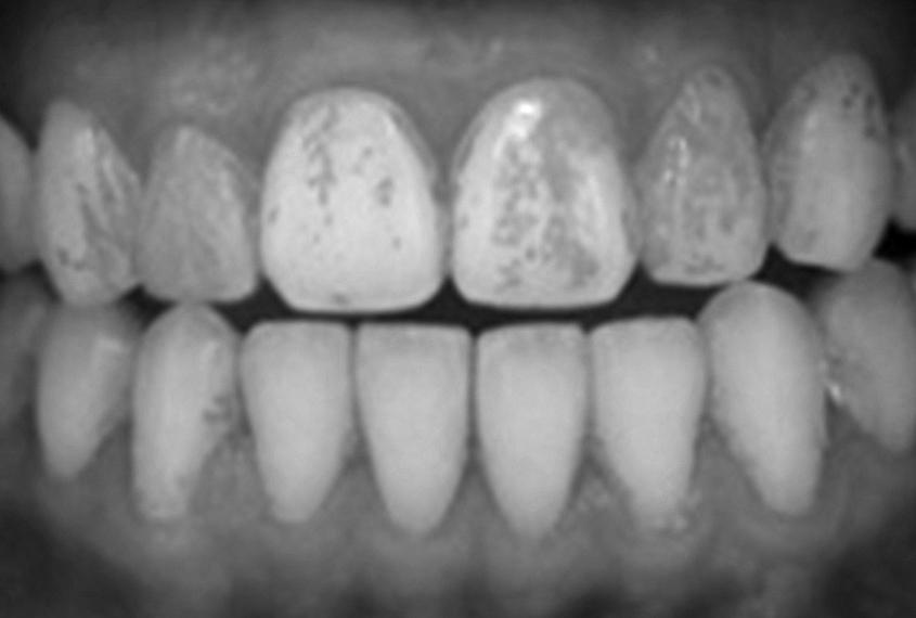 Interntionl Journl of Clinicl Preventive Dentistry Figure 1. Comprison of teeth clening efficcy by experimentl toothpstes. (A) toothpste. (B) Before brushing. (C) toothpste. (D) toothpste. Tble 8.