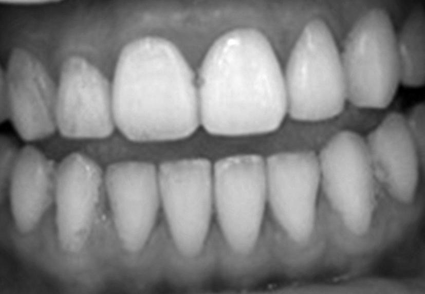 The results from clinicl interview, the subjects using test toothpste 2 cn feel whitening effect nd stisfction of clening more thn control nd test toothpste 1, significntly (p 0.05).