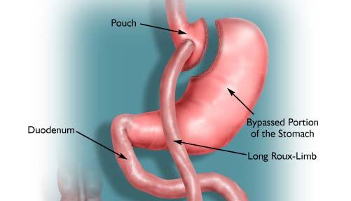 Roux-en-Y Gastric Bypass Combination Most tfrequently performed bariatric procedure in the