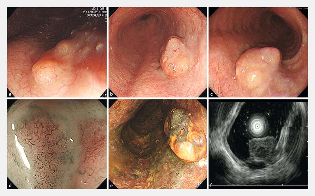 Fig.1 Endoscopic examination. a Esophageal SMT at first detection. b, c A well-defined non-pigmented elevated lesion with a flat proximal edge 2 years after first detection.