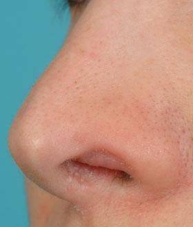 Losquadro et al. 221 Figure 7 Oblique view of patient with an exposed composite graft pushing vestibular skin below the nostril margin.