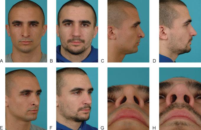 Losquadro et al. 223 Figure 11 Patient with severe alar retraction after rhinoplasty. Lateral crural strut grafting with caudal repositioning was used to correct the retraction.