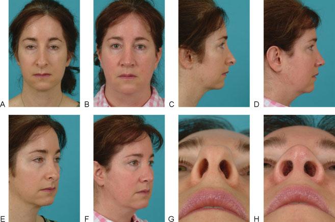 Figure 12 Patient with severe alar retraction after rhinoplasty. She also has a prominent infratip lobule on frontal view.