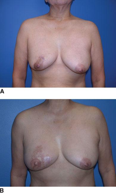 Breast Reconstruction/Kronowitz and Kuerer 903 FIGURE 9.