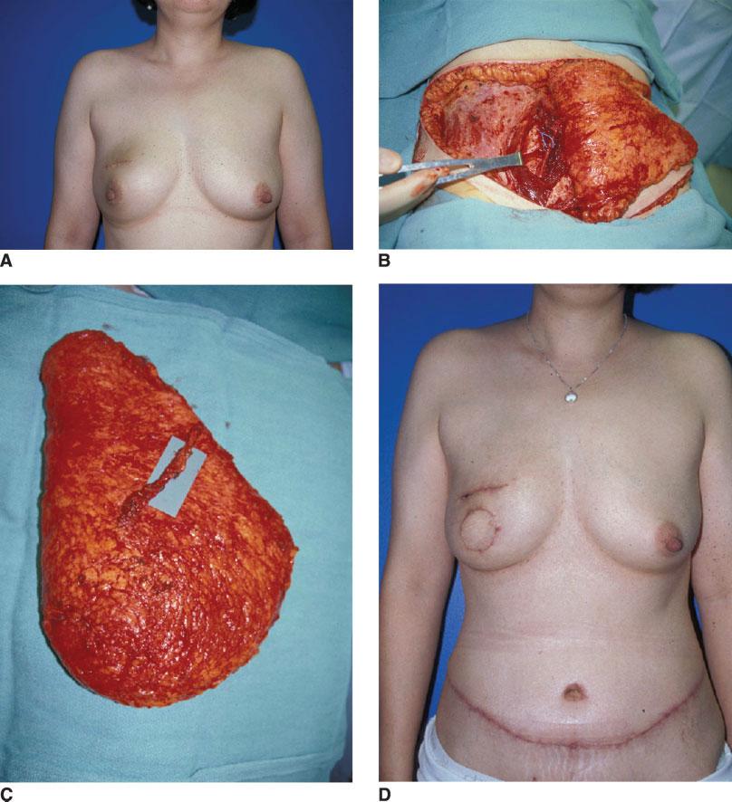 Breast Reconstruction/Kronowitz and Kuerer 905 FIGURE 10. These are views showing the aesthetic outcomes of a deep inferior epigastric perforator (DIEP) flap breast reconstruction.