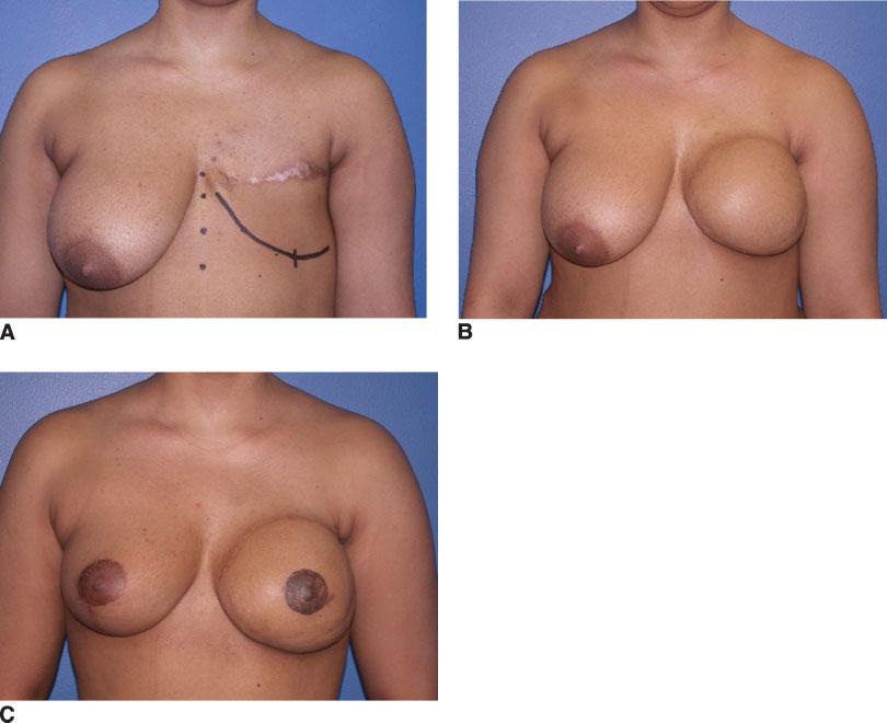 894 CANCER September 1, 2006 / Volume 107 / Number 5 FIGURE 1. These views illustrate delayed reconstruction after postmastectomy radiation therapy (PMRT).