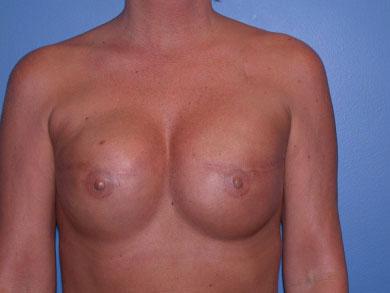 Breast Reconstruction/Kronowitz and Kuerer 901 method of breast reconstruction is that the surgical andrecoverytimetendtobethemostrapid.