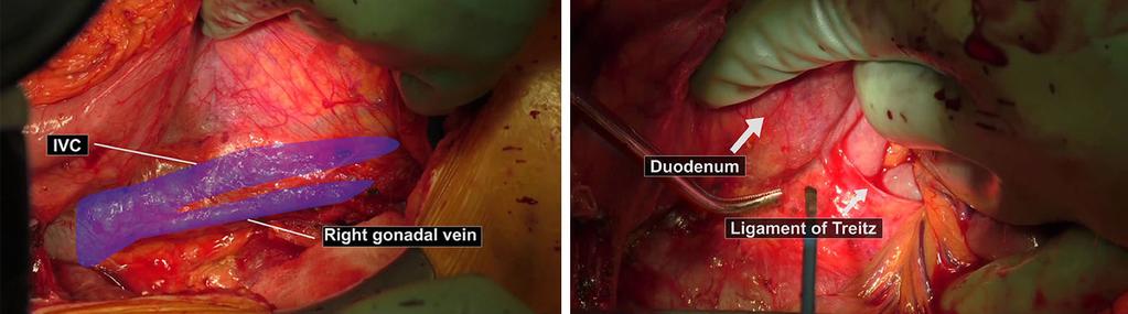Art of Surgery, 2017 Page 3 of 5 Figure 2 The line of Toldt was dissected until to duodenum and ligament of Treitz using Cattell-Braasch maneuver, exposed the IVC, L.