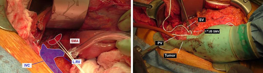 A tunnel was created between the pancreas and the confluence of PV, splenic vein and first jejunal branch of the SMV, transected the pancreatic neck after confirming resectability of the tumor.