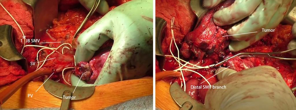 Another vascular clamp was applied to the main SMV branch at the root of mesentery. The SMV was resected both proximally and distally to the clamps and removed en bloc.