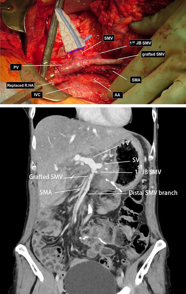 Page 4 of 5 Art of Surgery, 2017 tumor was located in the pancreatic head and uncinate process and invaded the peripancreatic soft tissue and the SMV.