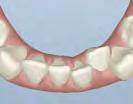 It s more predictable to treat crowding with Invisalign aligners if... anterior teeth are retroclined or upright.