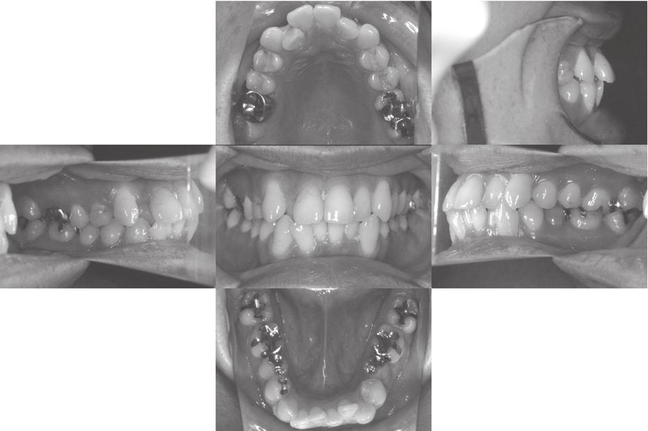 Dental Med Res. 34 Severe Crowding Treated with Invisalign 37 Fig. 1 Pre-treatment.