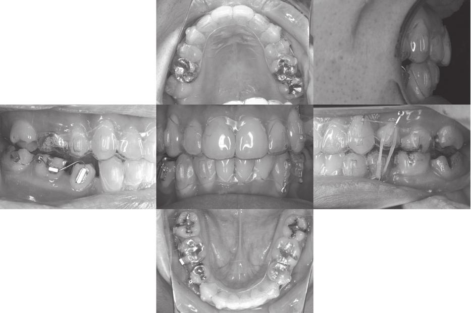 38 Y. Ogura and others Dental Med Res. 34 Fig. 9 Post-treatment facial. Fig. 7 Extrusion of the maxillary and mandibular second premolars on the left side using elastics. Fig. 8 Treatment results.