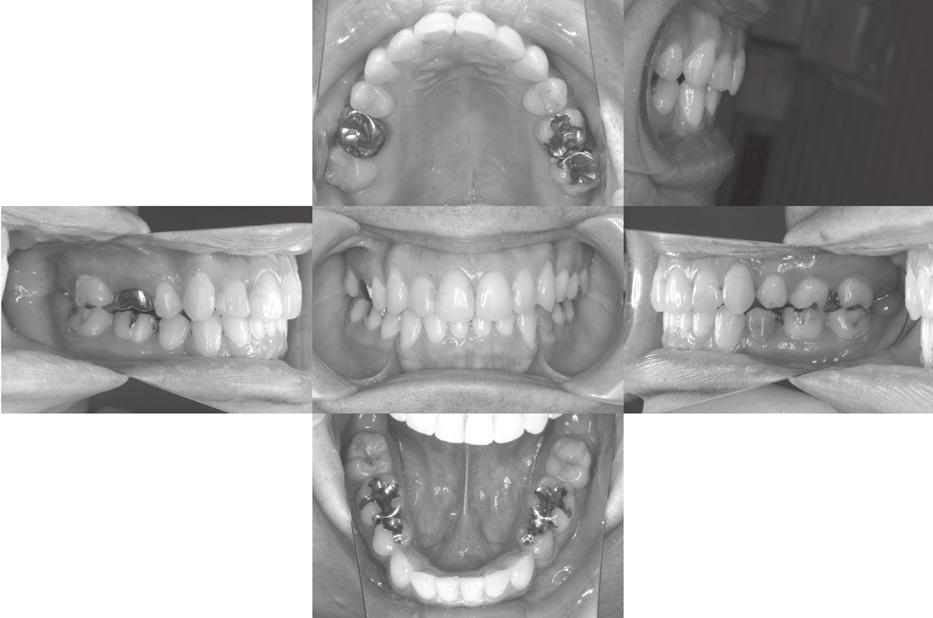 Power arms were also attached to the left mandibular canine and second premolar to further alleviate the bowing effect. Subsequently, we started the elastic-combined Invisalign treatment (Fig. 6).