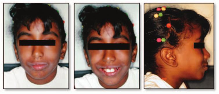 Figure 1. Pretreatment extraoral photographs. Figure 2. Pretreatment intraoral photographs showing previous extractions of the deciduous canines.