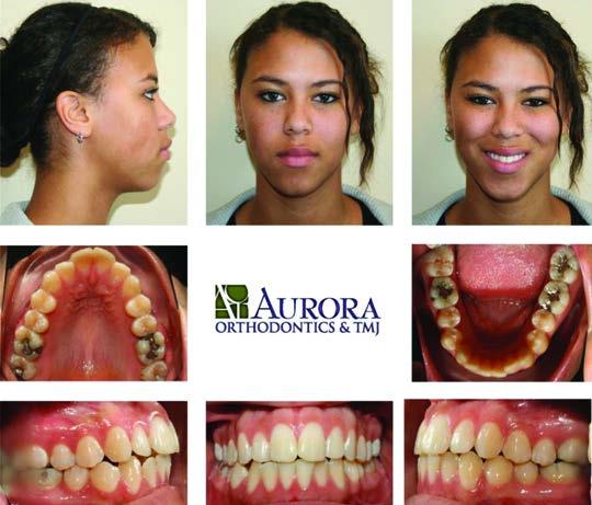 Pretreatment photos (note narrow palate) Since her main aesthetic problem was that her narrow arch forms accentuated her front teeth, we widened her smile with upper and lower expansion appliances
