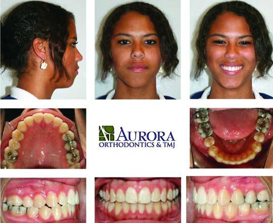 End of treatment photos When performing any orthodontic correction, the ultimate objective of The Lauson System is to create a