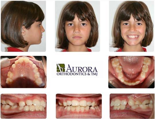 Photos after completion of phase I treatment (note corrected centerline) The treatment performed as an initial phase treatment reached the objective of correcting a deficiency in the upper jaw in