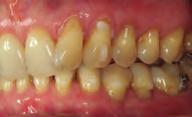 In patients with hooks on canines, we also bond attachments on these teeth to avoid undesired rotations or angulations due to the elastic force In the lower arch, the patient had horizontal